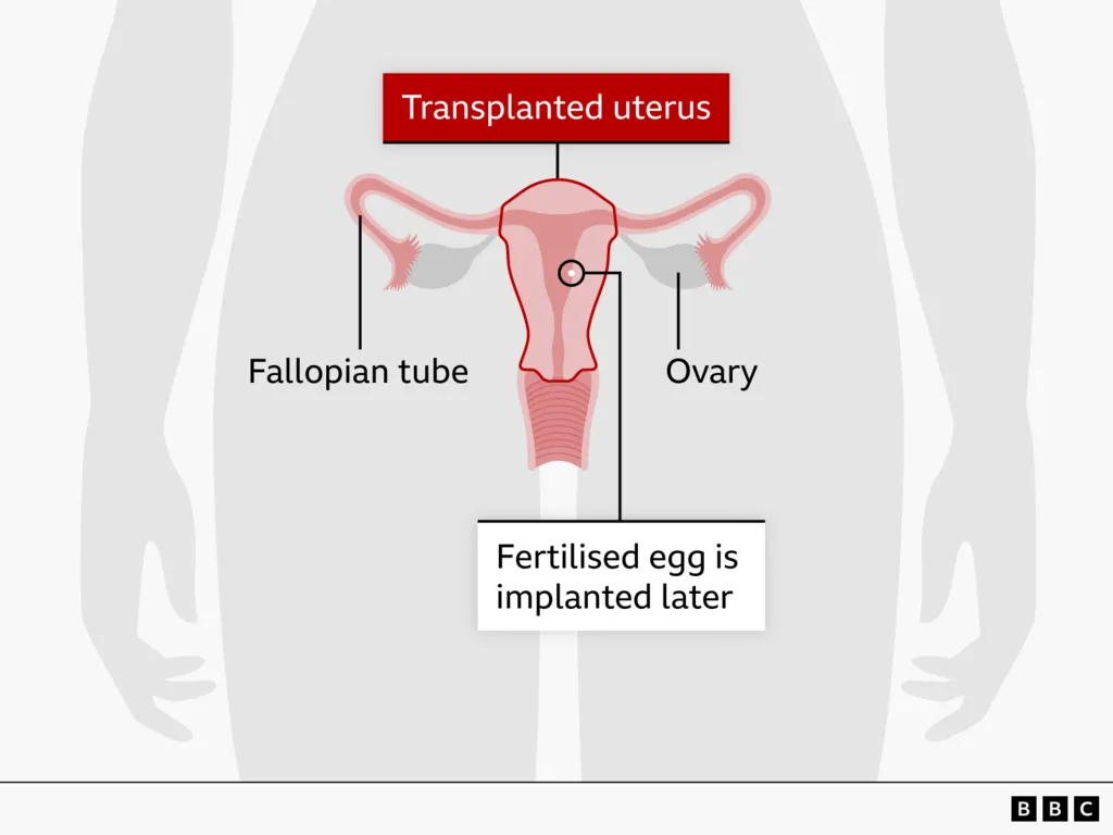 Diagrami_i_transplantit